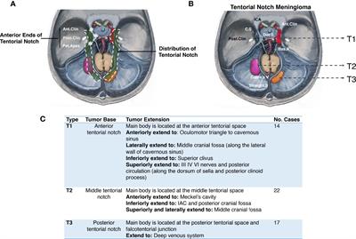 Surgical Management of Tentorial Notch Meningioma Guided by Further Classification: A Consecutive Study of 53 Clinical Cases